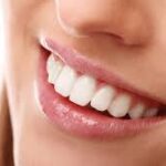 What to Know Before Choosing Composite Bonding Newcastle