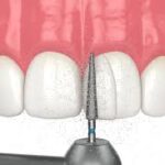 The Practical Benefits of Composite Bonding Middlesbrough Explained