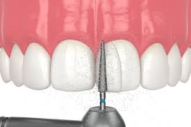 The Practical Benefits of Composite Bonding Middlesbrough Explained