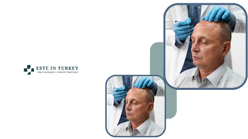 Hair Transplant Turkey