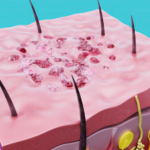 The Complete Guide to Open Pores Laser Treatment: What US Patients Need to Know Before Booking