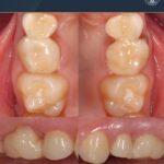 One Missing Baby Molar Changed Where Two Adult Teeth Could Land