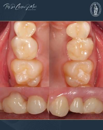 One Missing Baby Molar Changed Where Two Adult Teeth Could Land